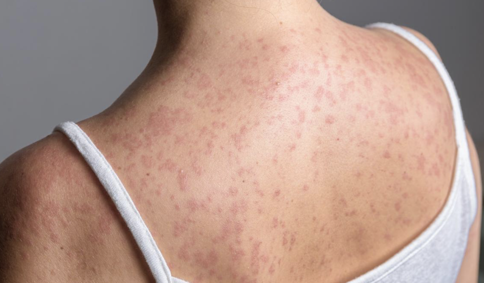Measles Cases Reported In DeKalb And LaGrange Counties